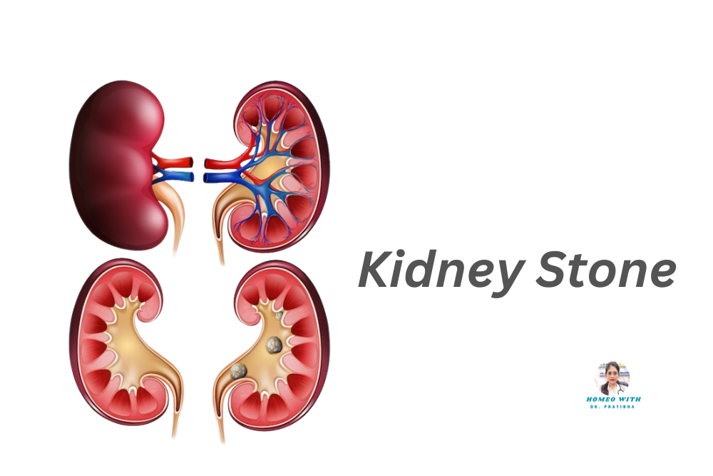 Kidney Stone